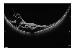 Ultra Widefield Adapter für REVO OCT