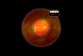 Volk Pan Retinal 2.2 - schwarz / mit individueller Gravur