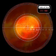 Volk ind. vitreo Kontaktglas Central Retinal Standard oder SSV